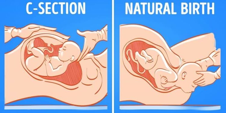Beyond ‘harvested babies’: Why women fear Caesarean Section