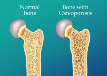 Bone health: Doctor warns against osteoporosis as accident victim recounts ordeal